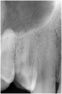 上原1　抜髄　◎